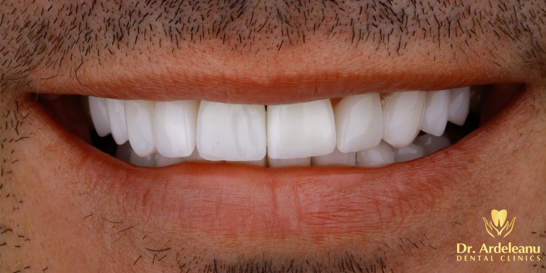 fatete dentare