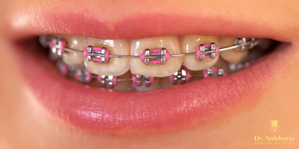 aparat-dentar-lp-1