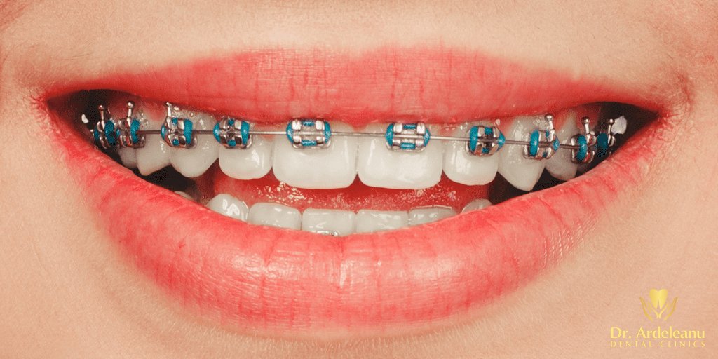 aparat-dentar-lp-2