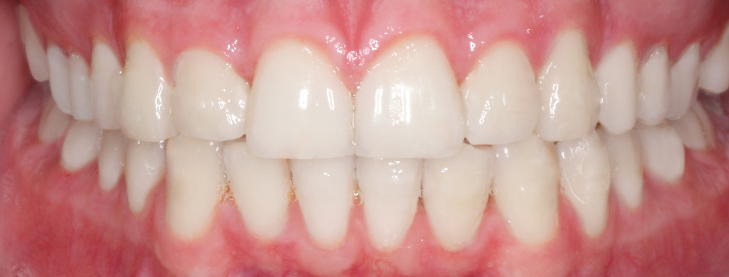 crossbite-teeth-after