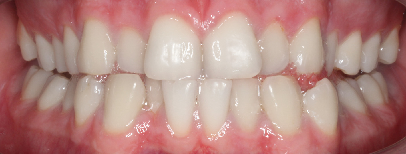 crossbite-teeth-before
