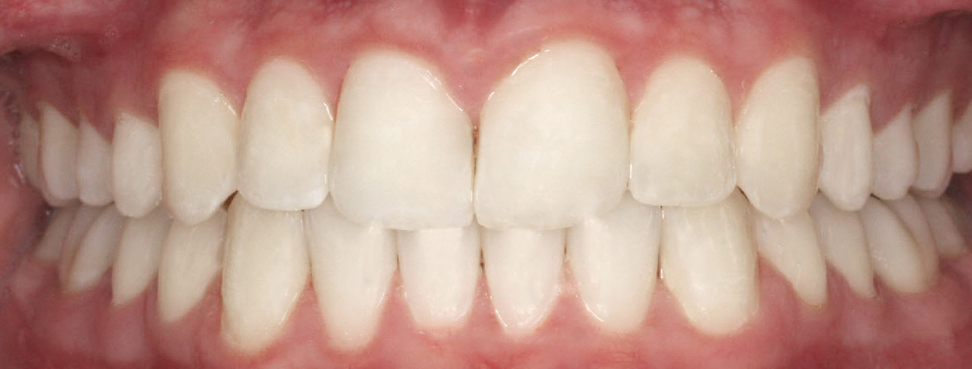 crowding-teeth-after_V2_0