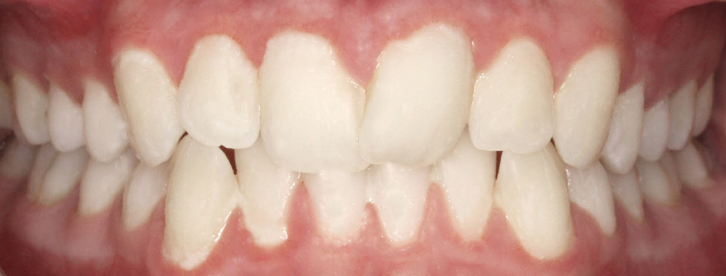 crowding-teeth-before_V2_0