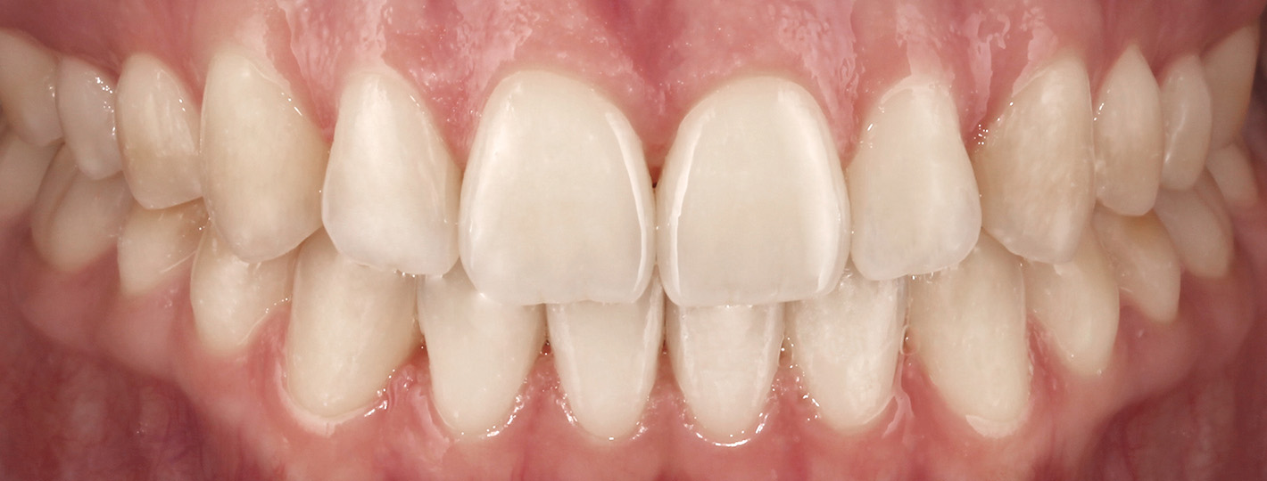 openbite-teeth-after