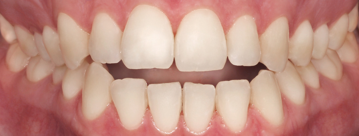 openbite-teeth-before
