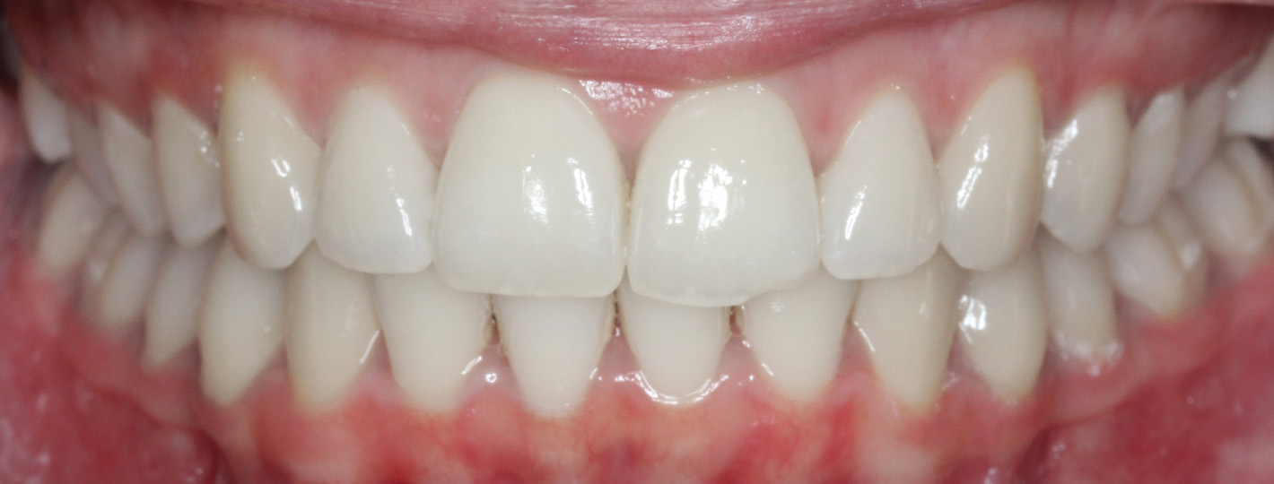 overbite-teeth-after