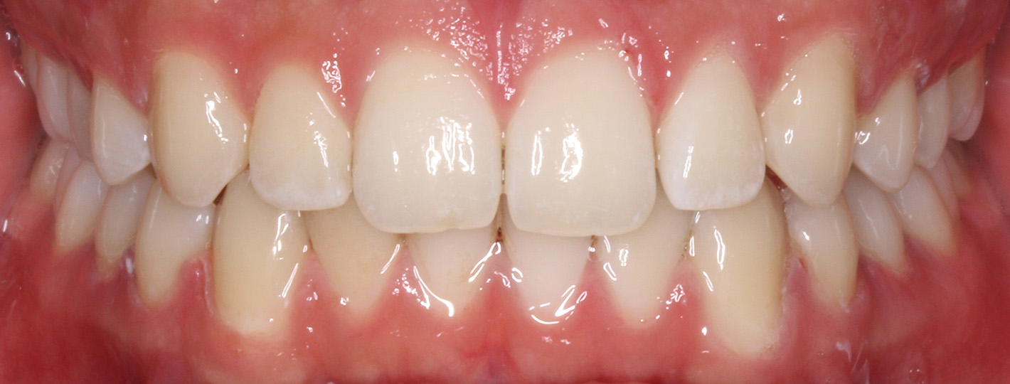 spacing-teeth-after