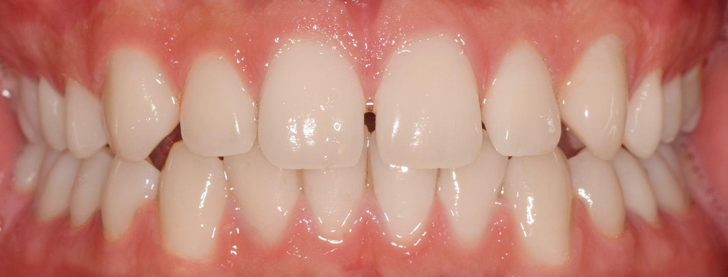 spacing-teeth-before