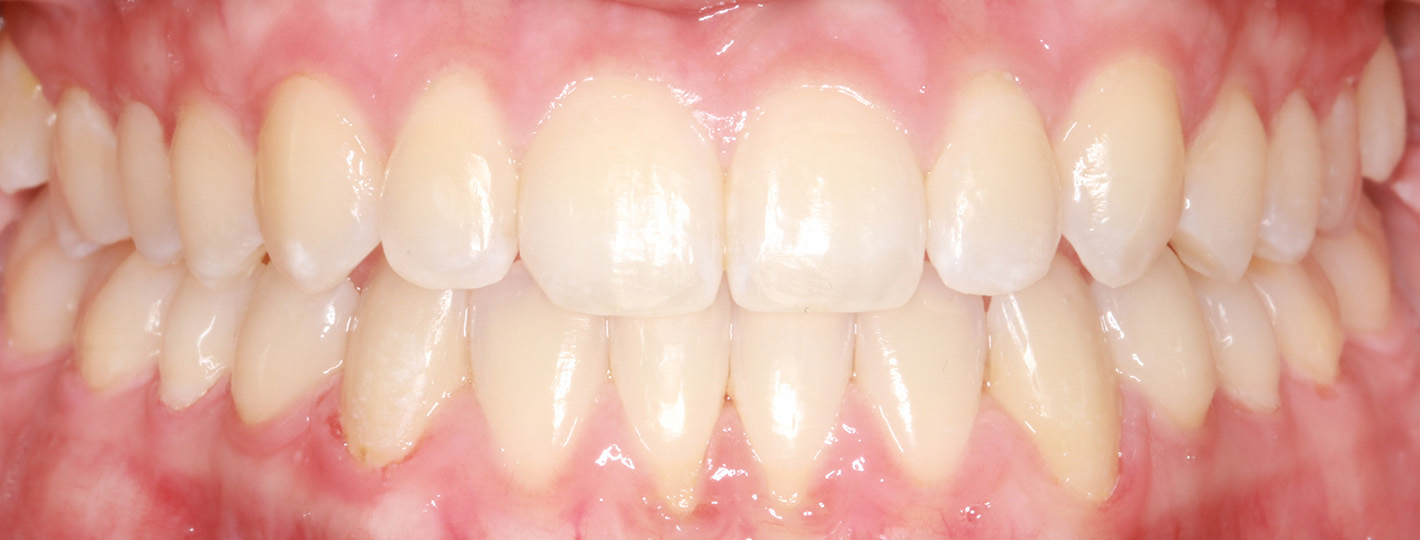 underbite-teeth-after