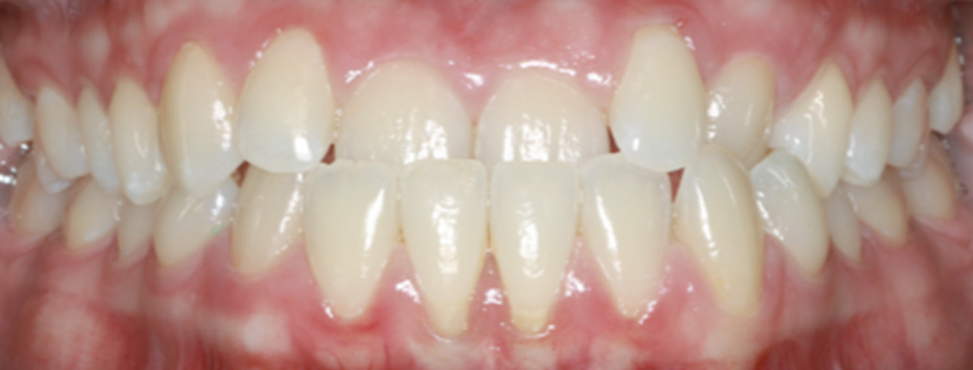 underbite-teeth-before