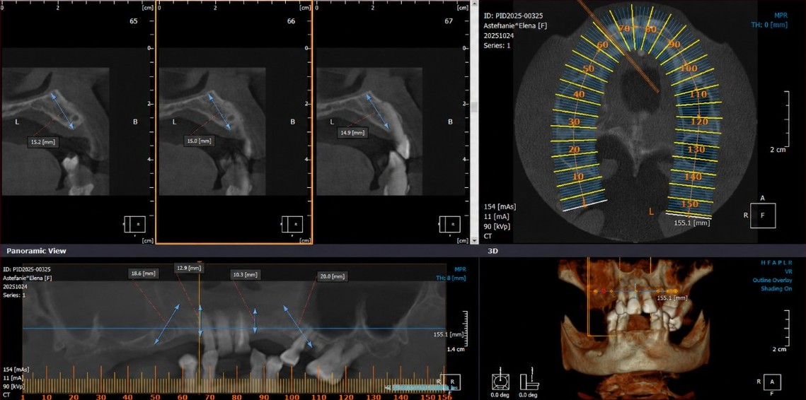Maxillary CBCT