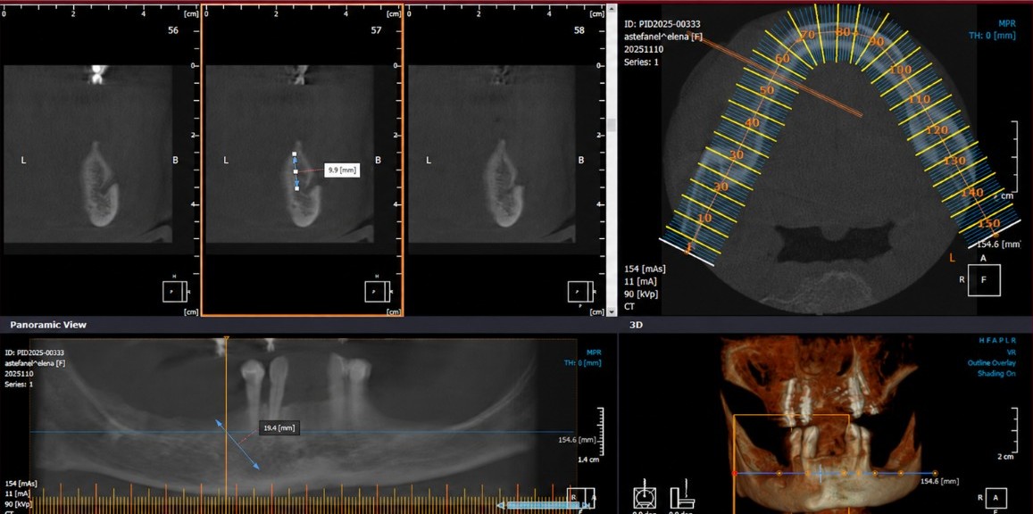 Mandibular CBCT