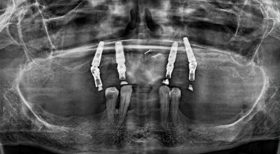 Dental radiograph