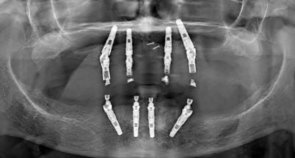 Post-operative radiograph — bimaxillary All-on-4
