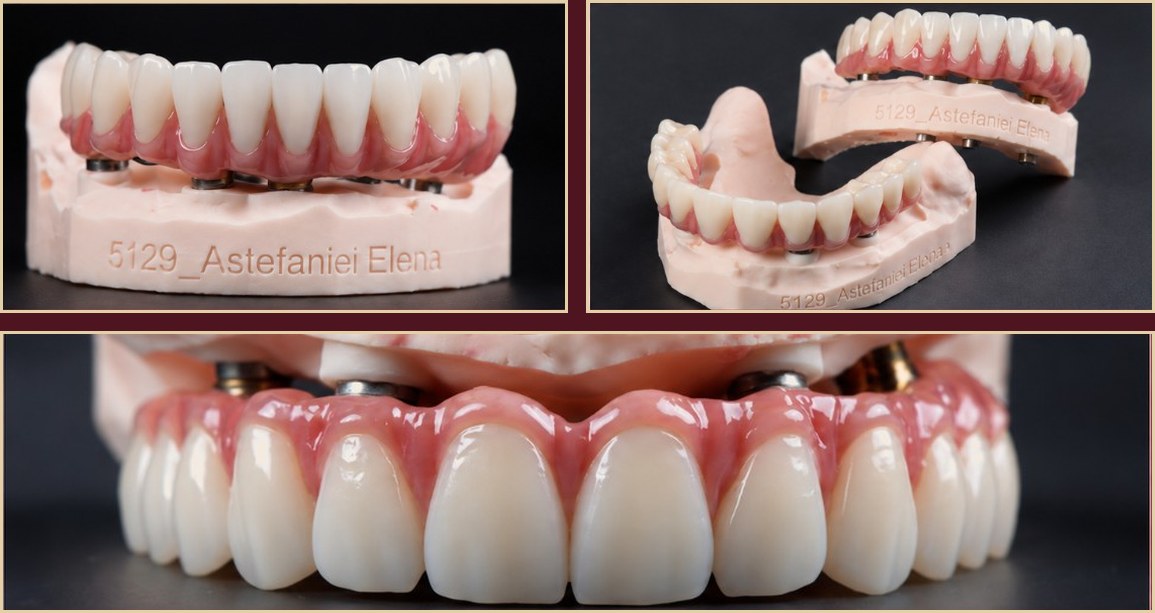 Final prosthesis