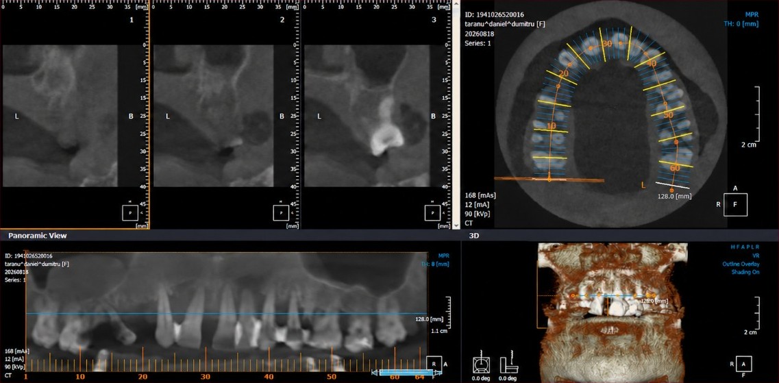 Maxillary CBCT