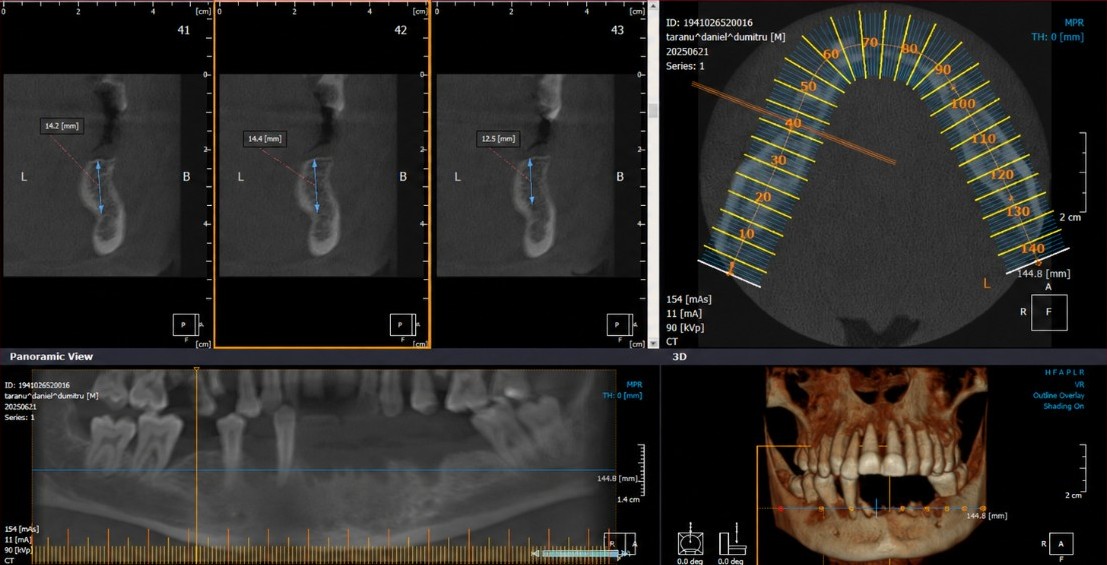 Mandibular CBCT