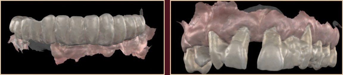 Intraoral scanning — Medit i900