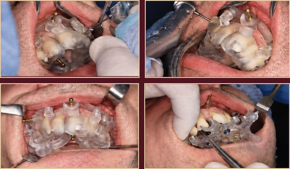 Surgical guide placement
