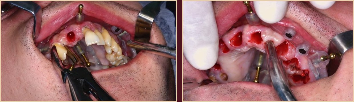 Dental extractions