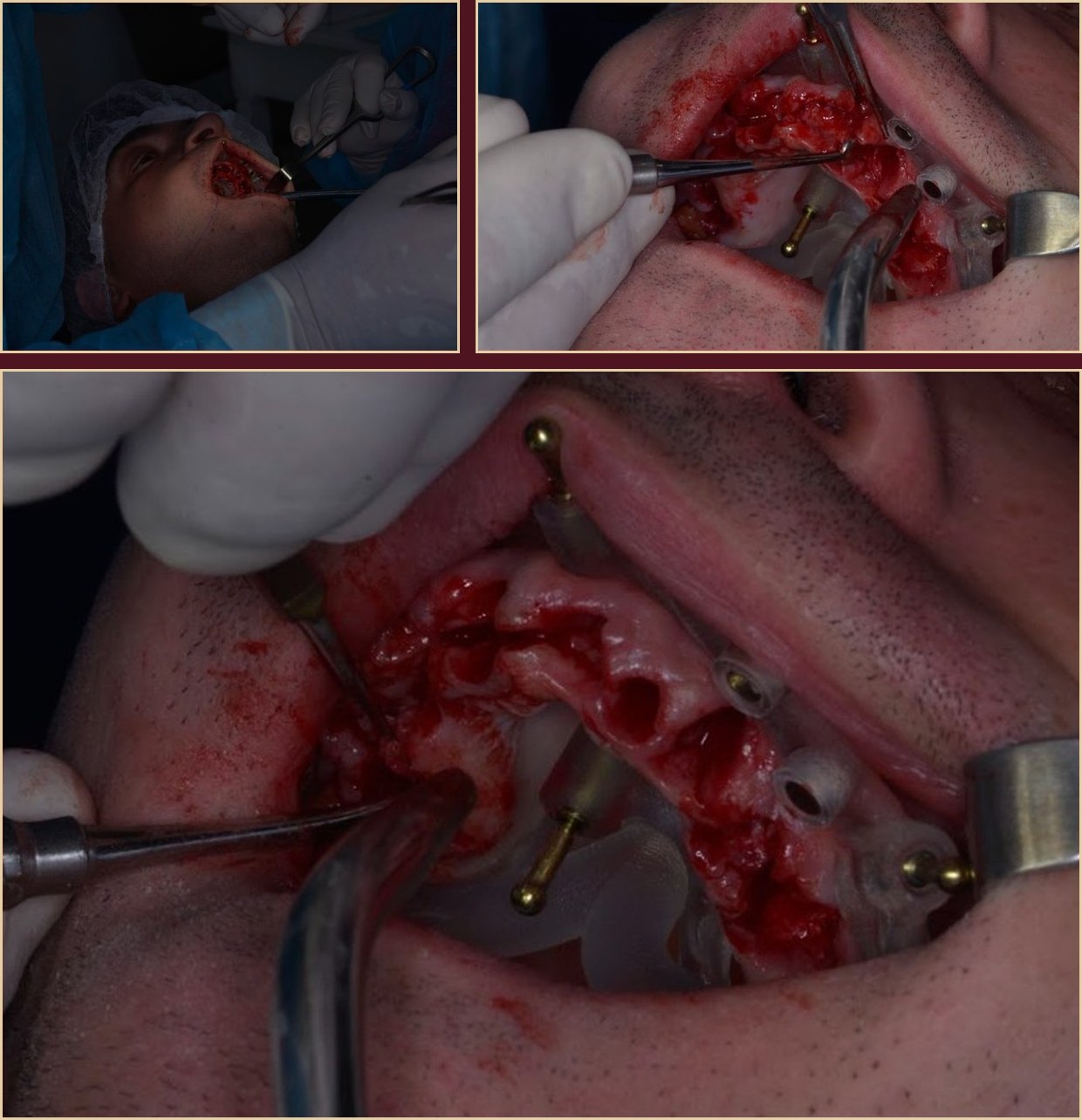 Flap preparation