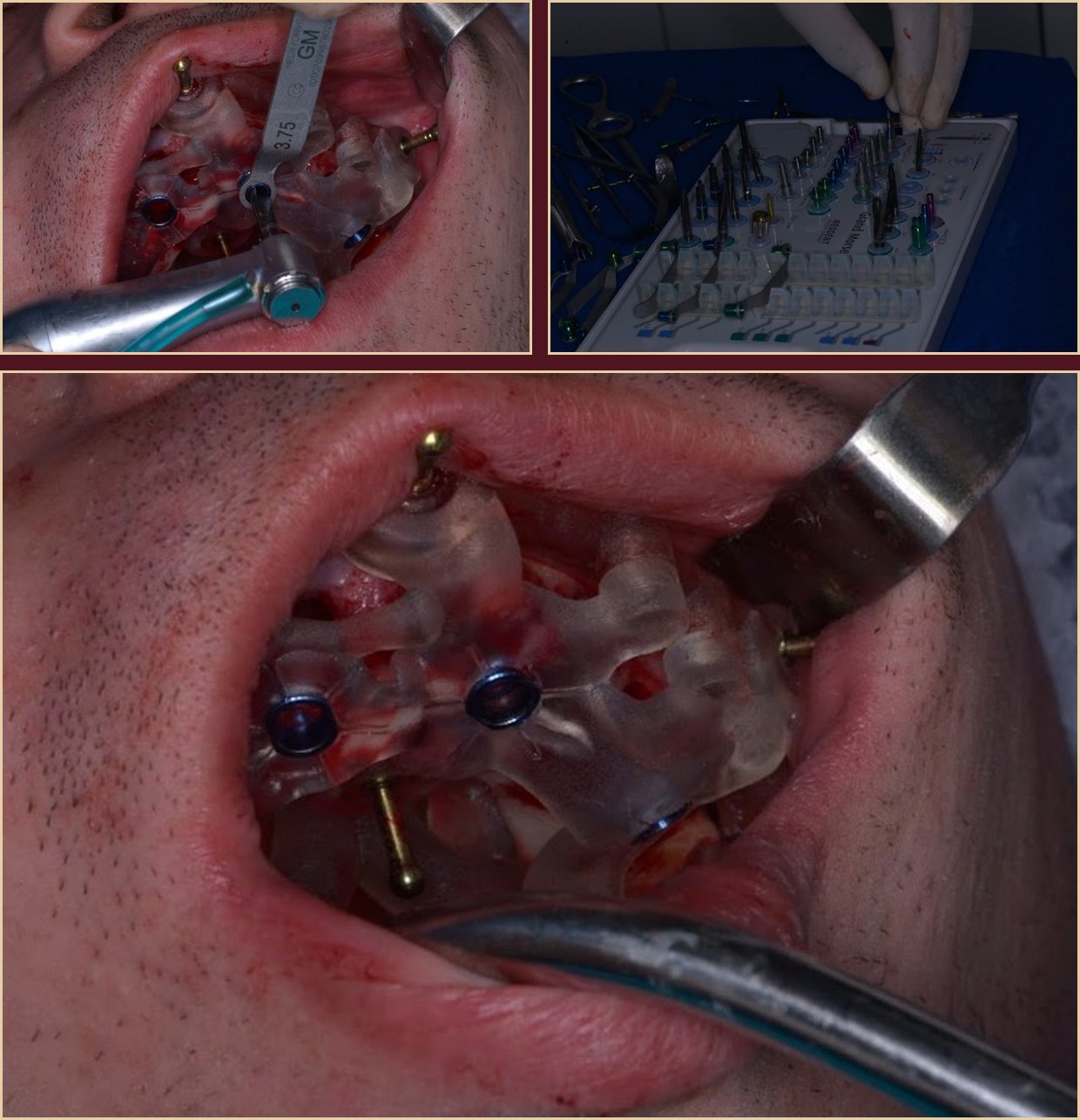 Preparation for implant insertion