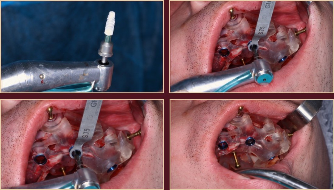 Implant placement
