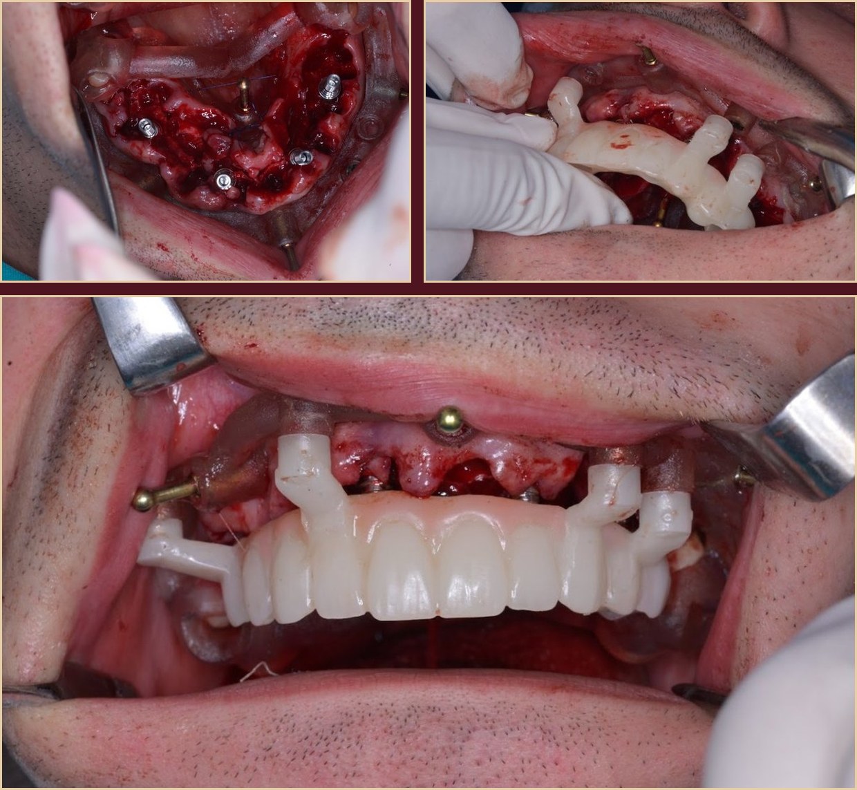 Implant placement and provisional restoration