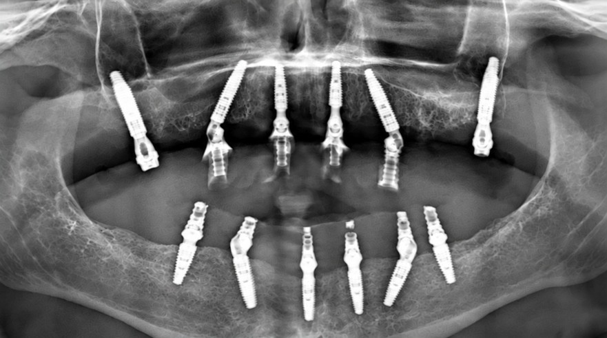 Post-operative radiograph — bimaxillary implants
