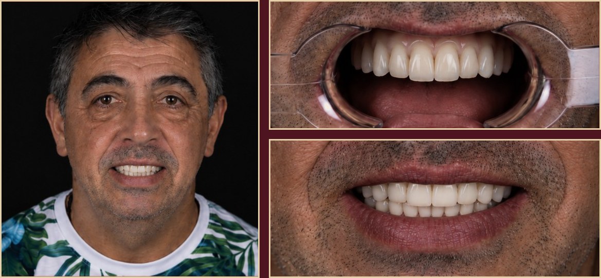 Provisional prosthesis & final photos