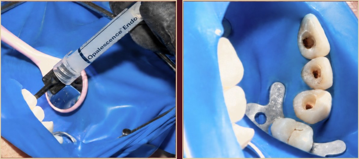 Internal tooth bleaching