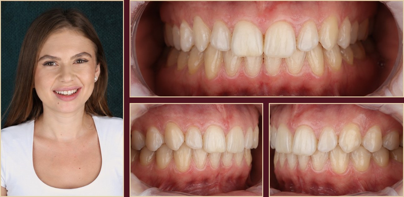 After internal bleaching