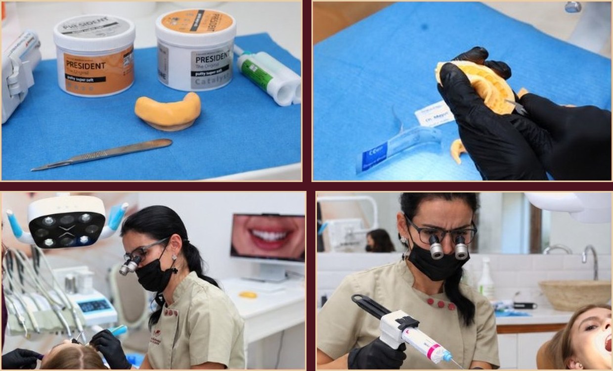Tooth preparation for veneers