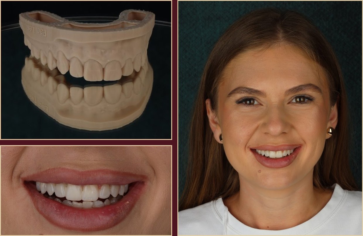 Wax-up and mock-up