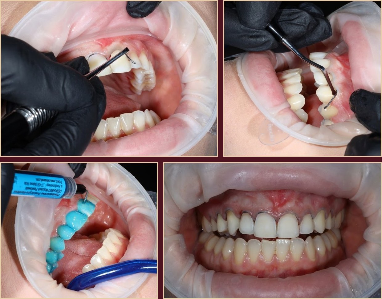 Veneer cementation