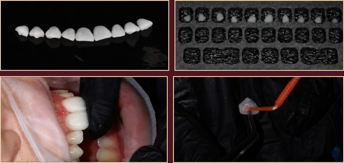Dental veneers