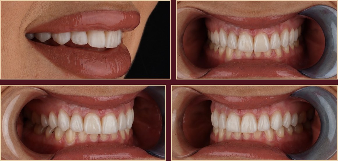 Final result after one week — intraoral